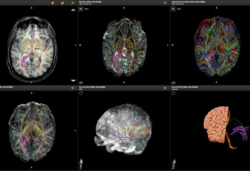 Estudio preliminar de segmentación cerebral para analizar el proceso de las distintas áreas del cerebro