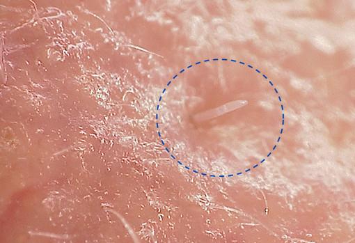 Image montrant l'acarien Demodex folliculorum sur la peau au microscope Hirox