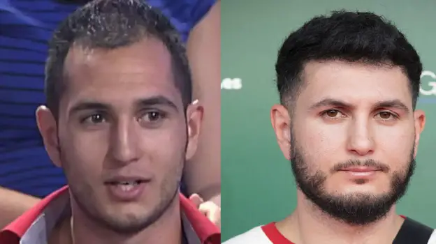 Omar Montes enne ja pärast juuste siirdamist